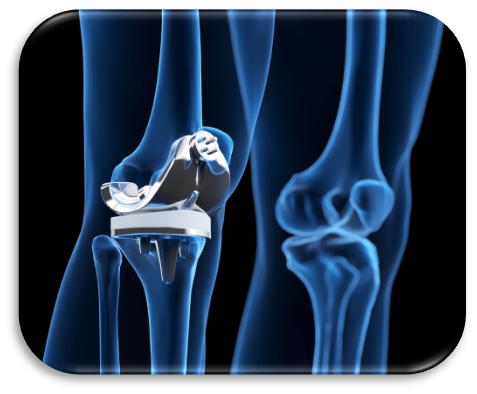 Knee replacement implant